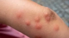 Алергија да го залажи клаоп