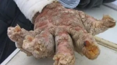 Што е опасна filyroза: симптоми и третман