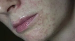 Демодекоза: што е, симптоми и третман