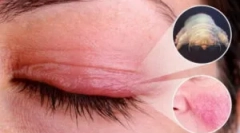 Демодекоза: причини, симптоми и третман