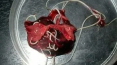 Црви во ткива на црниот дроб