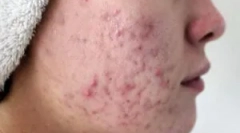 Како се пренесува демодикозата?