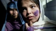 Како да се зарази со leishmeni: симптоми и третман на leishmaniosis