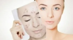 Третман на демодикоза на лицето на лицето