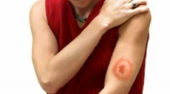 Третман на borreleiosis -оза