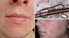 Анализа на испорака на демодекоза