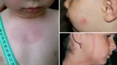 Симптоми и третман на borreliosis во дете