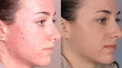 Значи за третман на демодикоза