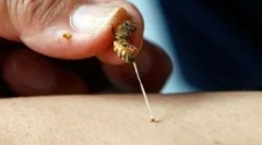 Средства од британски каснувања