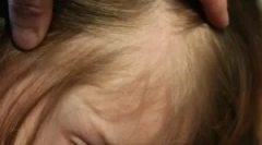 Вошки и шорцеви во косата во дете